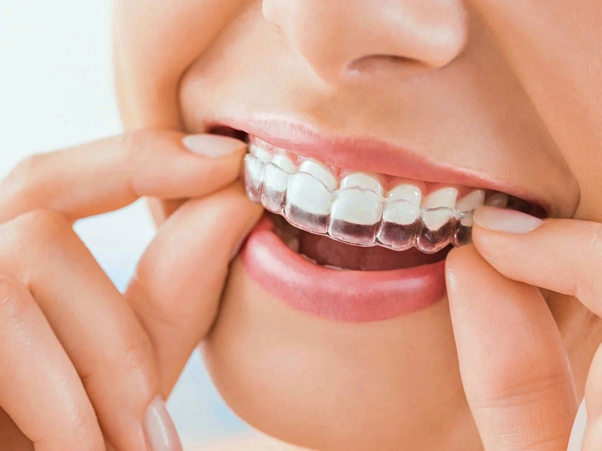 ПРОЗРАЧНЫЕ ЭЛАЙНЕРЫ