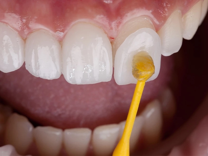 КЕРАМИЧЕСКИЕ ВИНИРЫ