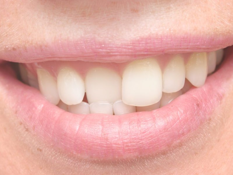 Неровно стоящие зубы