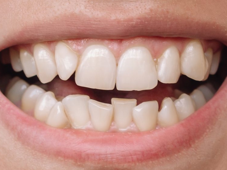 Скученность передних зубов