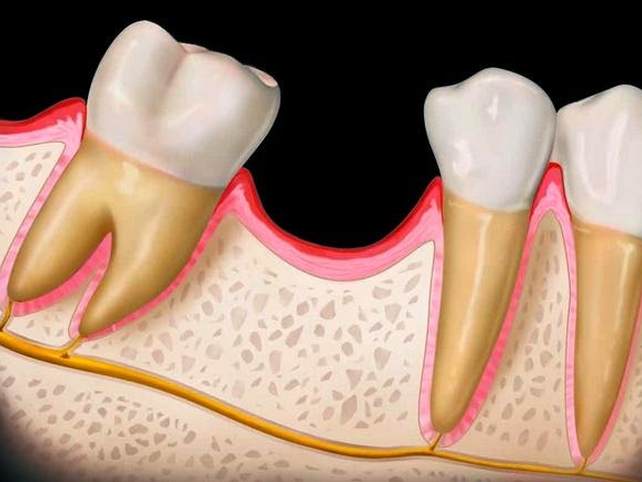 Подготовка к имплантации
