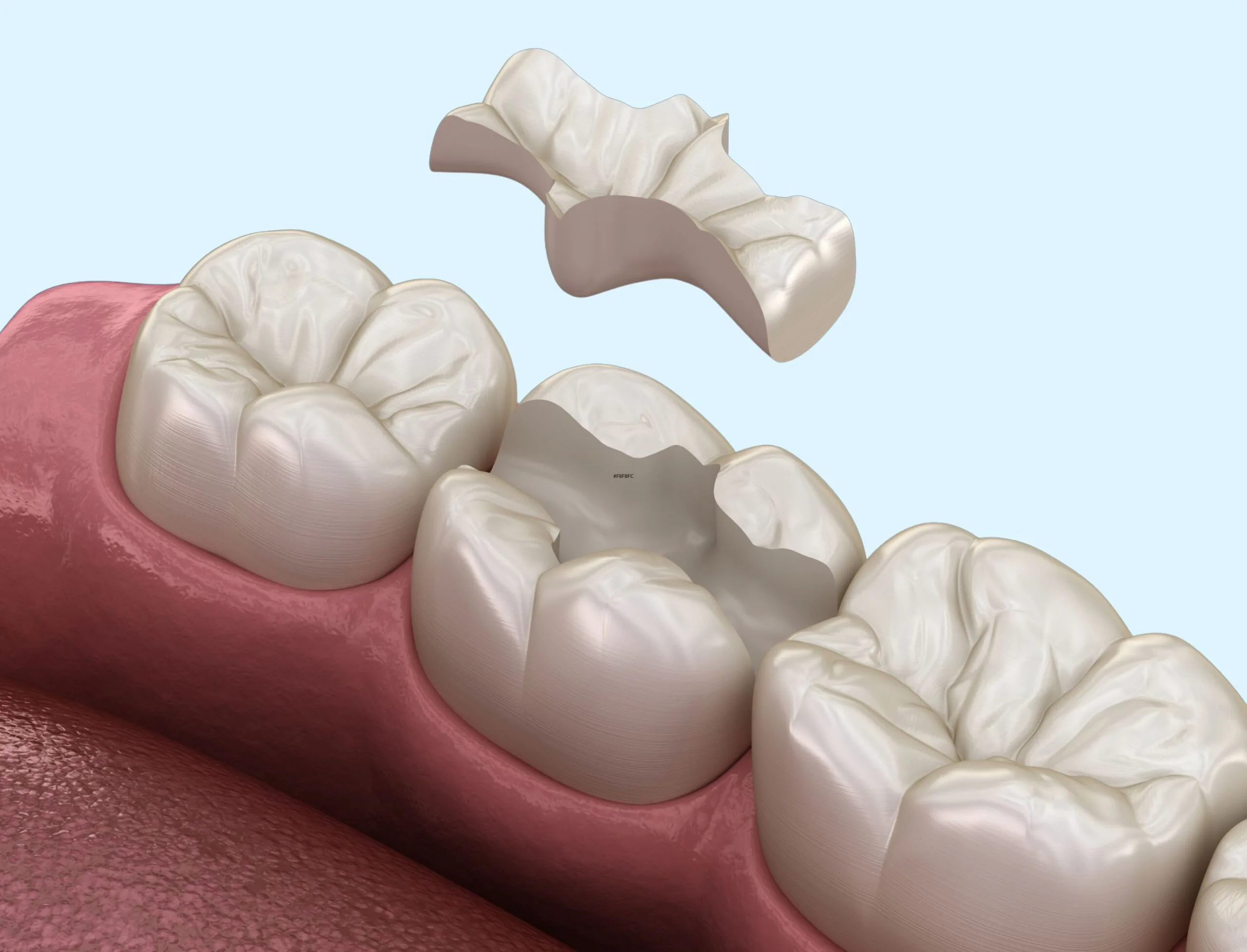 КЕРАМИЧЕСКИЕ ВКЛАДКИ