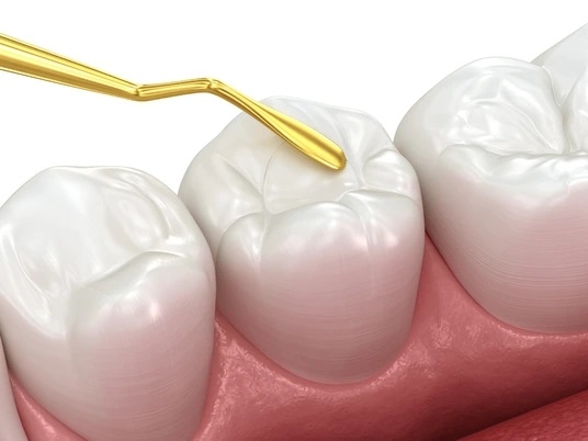 КОМПОЗИТНЫЕ РЕСТАВРАЦИИ