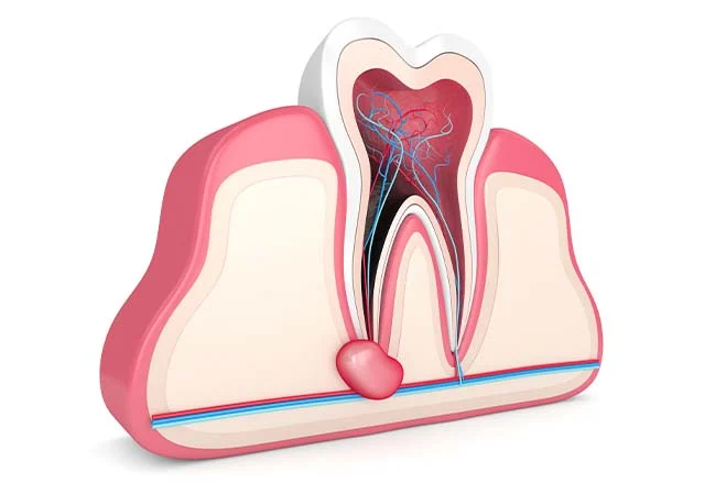 ПЕРИОДОНТИТ (киста)