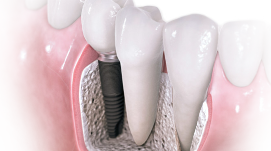 ИМПЛАНТАЦИЯ