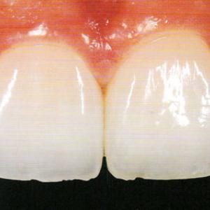 керамические виниры на передних зубах фото