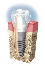 протез зубной на импланте фото