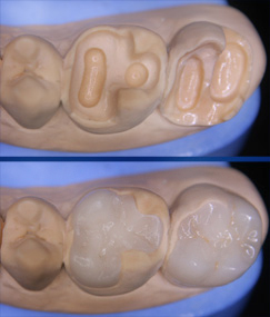 керамические протезы на зубы фото
